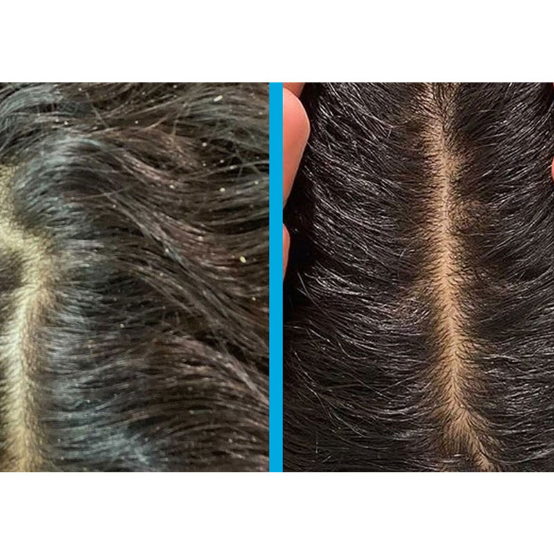 Scalp Scrub Exfoliating Anti Dandruff Treatment